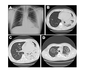 Diagram showing changes in chest cavity during active stages of the disease (Swanson, & Heuner, 2008).