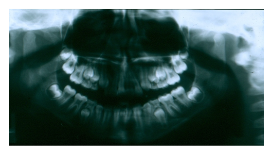 Autogenous Tooth Transplantation: Five -Year Re-Evaluation of a Vital Transplant, Case Study Example