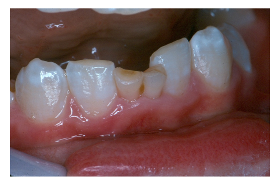 Autogenous Tooth Transplantation: Five -Year Re-Evaluation of a Vital Transplant, Case Study Example