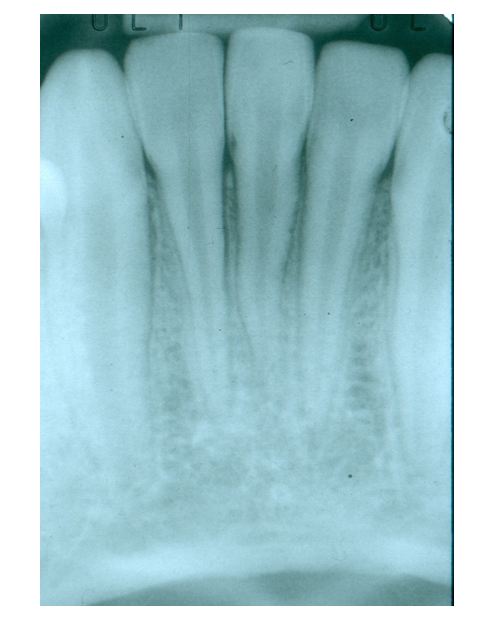 Autogenous Tooth Transplantation: Five -Year Re-Evaluation of a Vital Transplant, Case Study Example