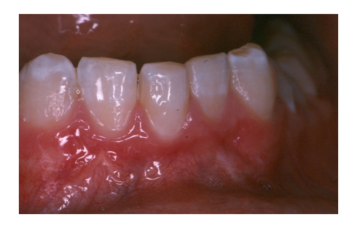 Autogenous Tooth Transplantation: Five -Year Re-Evaluation of a Vital Transplant, Case Study Example