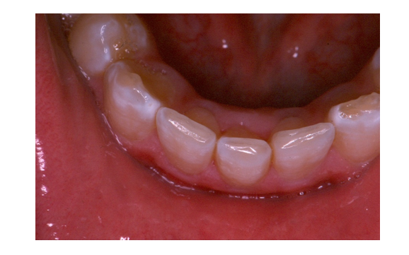 Autogenous Tooth Transplantation: Five -Year Re-Evaluation of a Vital Transplant, Case Study Example