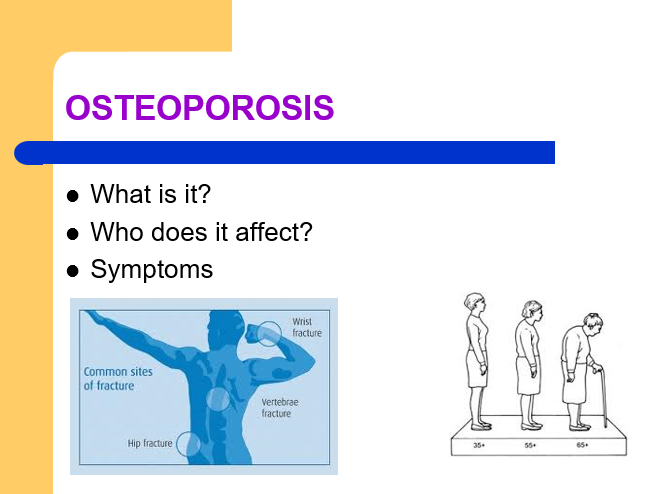 OSTEOPOROSIS