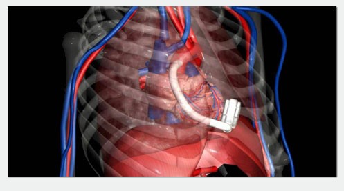 representation of the inserted Ventricular Assist System